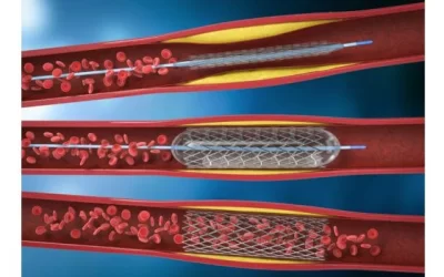 Angiography and Angioplasty