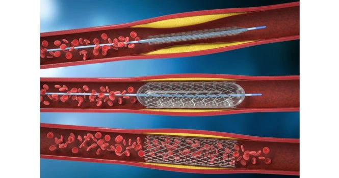 stent placement