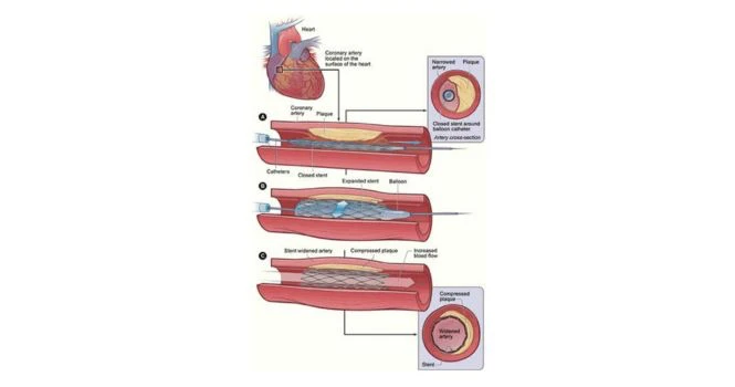 angioplasty diagram and image