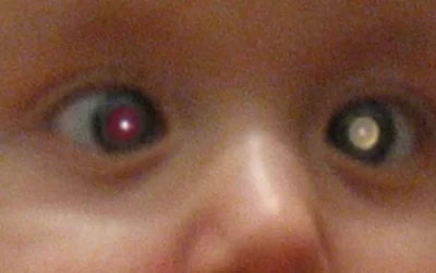 Retinoblastoma