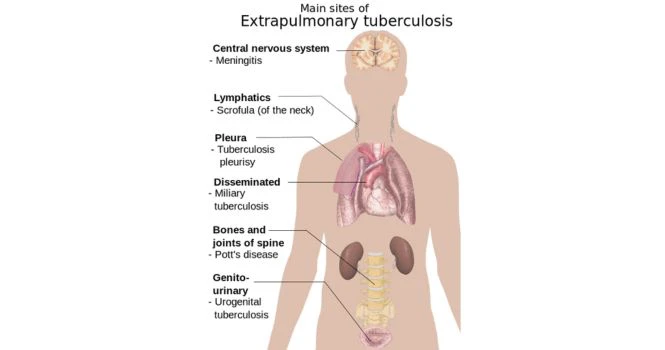 signs and symptoms of extra pulmonary TB