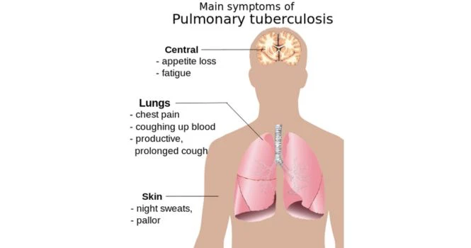 Signs and Symptoms of Pulmonary Tuberculosis