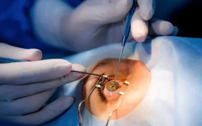 Cataract Surgery