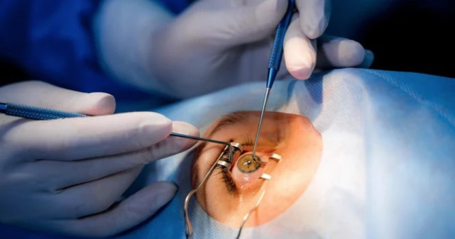 cataract surgery thumbnail