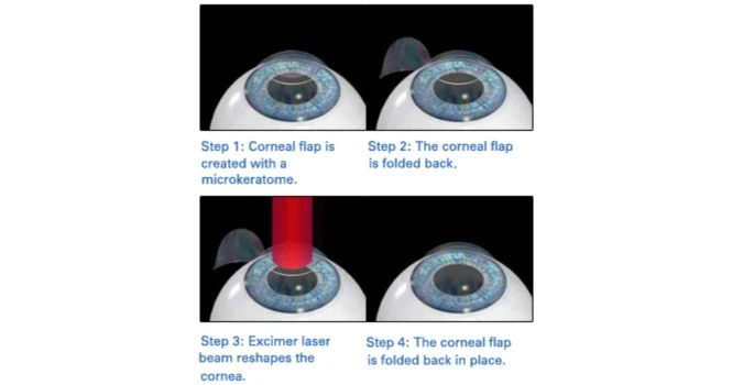 method of Lasik surgery