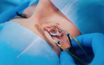 LASIK Surgery