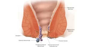 haemorrhoids