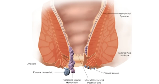 haemorrhoids