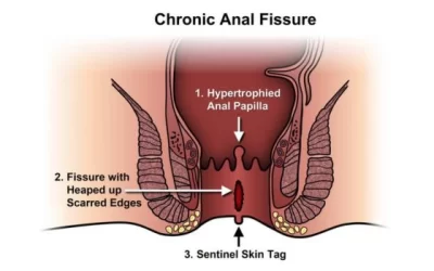Difference between Piles (Hemorrhoids), Fissures and Fistulas