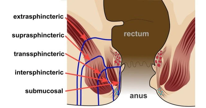 Anal Fistula diagram