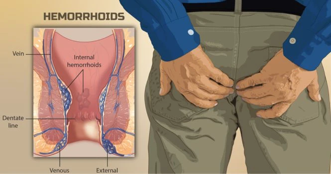 Piles or Hemorrhoids image