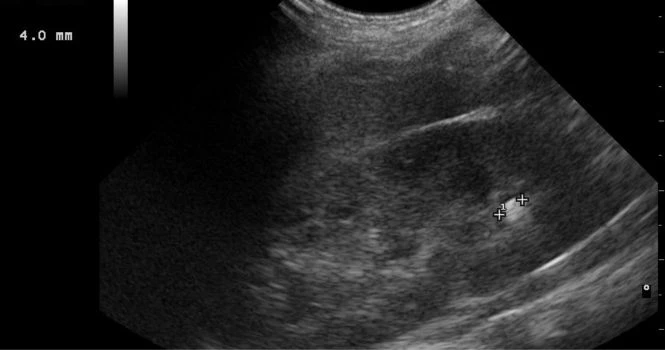 ultrasound for kidney stone