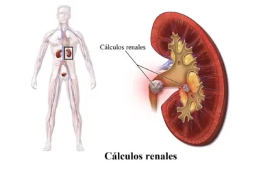Kidney Stone or Renal Colic or Urinary Stone Disease