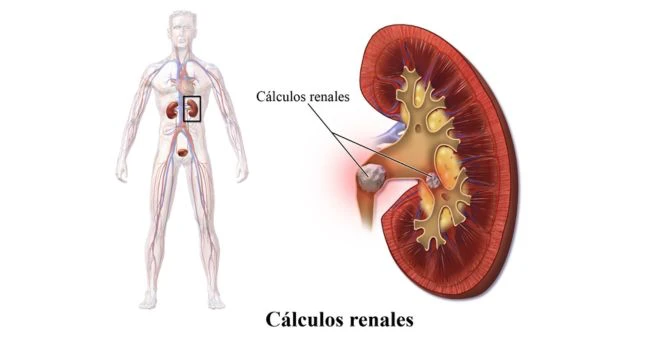 Kidney stones