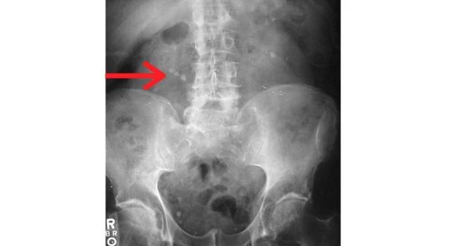 x ray kidney stone