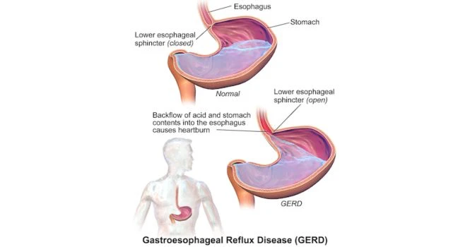 GERD Gastroesophageal reflux disease