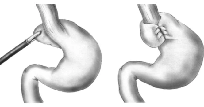 Laparoscopic Fundoplication