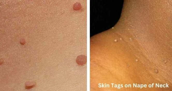 skin tag on nape of neck