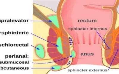 Difference Between Perianal Abscess and Haemorrhoid