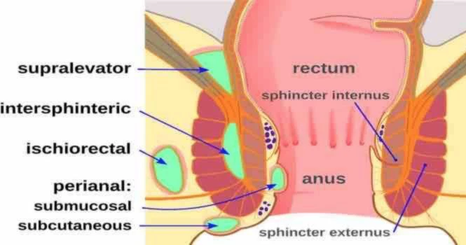 abscess around anus