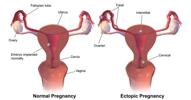 ectopic pregnancy