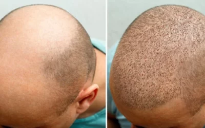 Hair Transplant in India: A Comprehensive Guide to Techniques, Costs, and Recovery