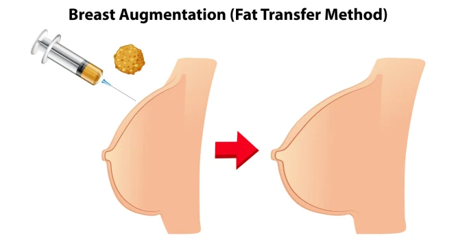 fat transfer breast enlargement