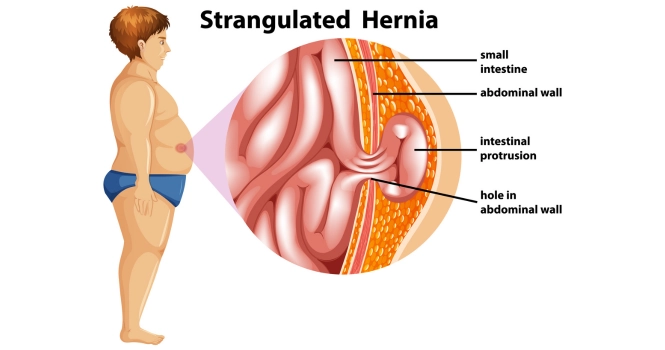 Strangulated hernia