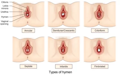 Hymenoplasty Surgery: Understanding the Procedure, Benefits, and Considerations of Hymen Repair Surgery