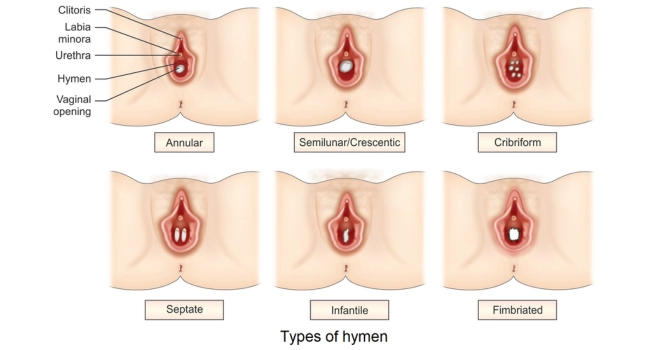 types of hymen